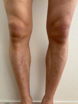 ブルーココア(BlueCocoa)/メンズ脚。4ヶ月後