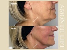 ミリュール(Millule)/自社開発マシンでたるみ改善