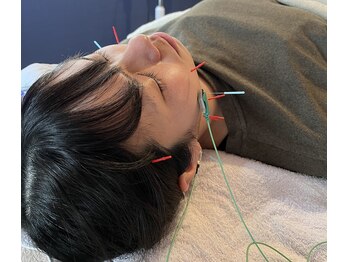 ラメール 京丹後(la mer)/美容鍼施術