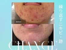 マインエム(mine.m)の雰囲気（《ピーリング×LDM×LED》で繰り返すニキビ・跡も根本改善）