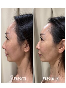 メディカルエース(MedicalAce)/ブライティングリフト