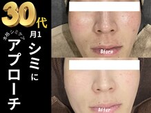 テセラ(Tethere)の雰囲気（ピンポイントでシミにアプローチ！）