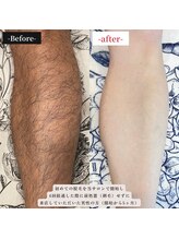 ダイア(DIA)/★圧倒的効果★ メンズ　足脱毛