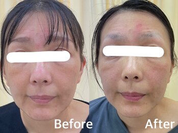 とだ鍼灸指圧治療院/当院No1メニューの美容鍼！