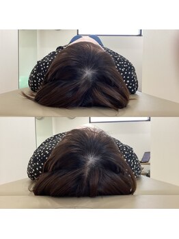 ランドル(rendre)/４０代女性　転倒後肩前面が痛い