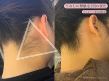 レスイズモア 恵比寿(less is more.)/【金の糸脱毛】うなじ1回の変化
