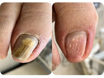 ロンディネ(Rondine)/トラブルネイル21