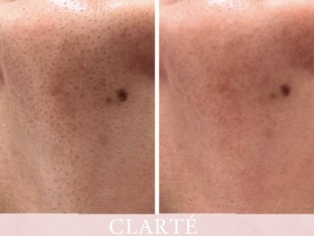 クラルテ(CLARTE)/小鼻ケア☆毛穴吸引1回の効果!
