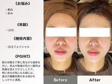 ルディラ 銀座店/白玉フェイシャル