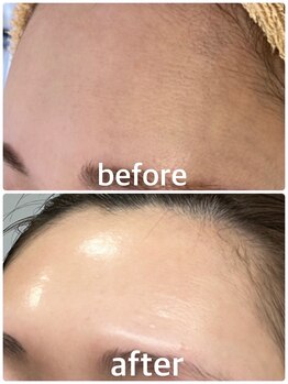 ベルシャトン(Belle Chaton)/HAABREPRO 毛穴改善