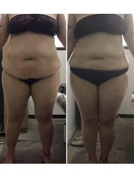 ビューティーワークスシャンティ 柏店(Beauty Works Shanti)/1ヶ月で短期間痩せ