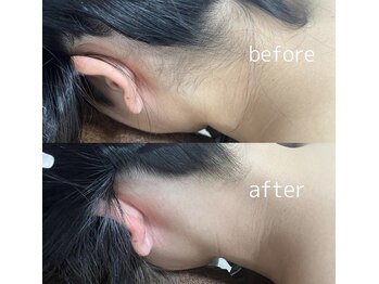 エミアンジュ(Emi Ange)/うなじ脱毛　Before&After