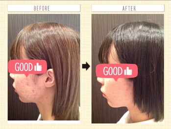 はる鍼灸整骨院/20代女性｜3ヶ月の結果