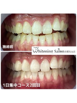ホワイトニングサロン 京都烏丸店/ホワイトニング施術例