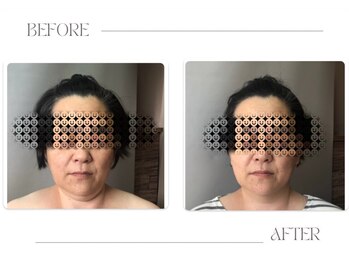 美骨鍼灸整骨院/二重顎とフェイスライン