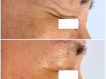 ボディメイキング キキ(Bodymaking KIKI)/目元のハリ低下を改善