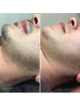 トリプルワン(111)/ヒゲWAX脱毛