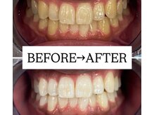 ホワイトニングサロン 宝塚/Before&After美白ホワイトニング