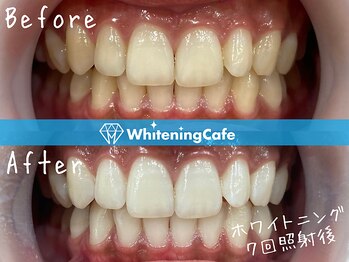 歯のホワイトニングWhiteningCafe六本木店【ホワイトニングカフェ】/ホワイトニングビフォーアフター