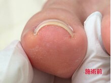 レフス 北参道店(REFUSS)/巻き爪矯正