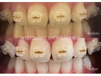 ホワイトニングショップ 福岡香椎店/美容ホワイトニングbefore after