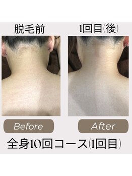 レア(LEA)/【レディース】うなじ・背中脱毛