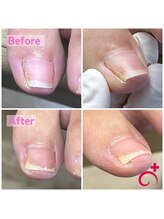 ドクター巻き爪 本厚木院(Dr.巻き爪)/40代女性！爪の痛み少なく綺麗に