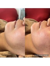 クレル(Clair)/フェイスラインbefore→after