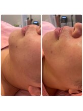 ヒメミ(Himemi)/ララピール&小顔マッサージ