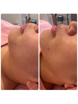 ヒメミ(Himemi)/ララピール&小顔マッサージ