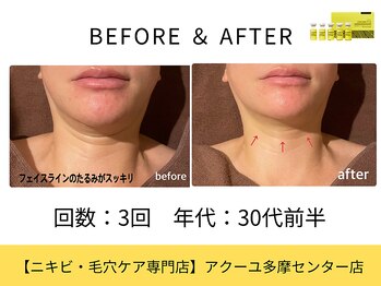 ア クーユ 多摩センター店/ レモンボトル/二重あご/小顔