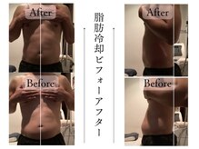 クローネ(Krone)/脂肪冷却ビフォーアフター