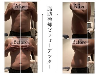 クローネ(Krone)/脂肪冷却ビフォーアフター