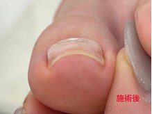 レフス 北参道店(REFUSS)/巻き爪矯正