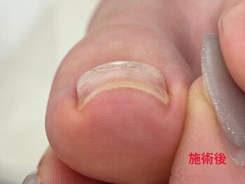 レフス 北参道店(REFUSS)/巻き爪矯正