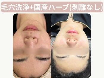 イーラボ 池袋店(e-LABO)の写真/【国産ハーブ使用/純度100%/剥離なし】×【毛穴洗浄/トルネード水流】で即効効果出し！ニキビケア/毛穴汚れ