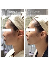 ダリア(Dahlia)/サーマトリックス＋小顔コルギ