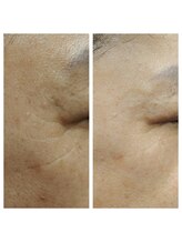 エム(M)/ララピール