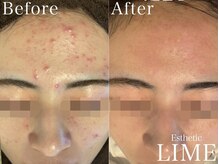 ベル 川越(Belle)/ハーブピーリング｜ニキビケア