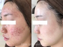 繰り返す頑固な大人ニキビケアはお任せください◎