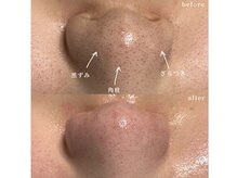 エルム 京都駅前店(elm)/＊肌育毛穴洗浄TENNYO＊