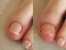 《Foot》巻き爪ケアメニュー★カウンセリングあり　1本/¥3300 &nbsp;2本/¥6600