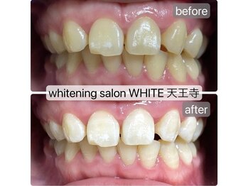 ホワイト 天王寺店(White)/ホワイトニング症例
