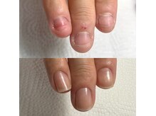 【JOCOネイルケア】深爪・自爪育成も専属スタッフ在籍で安心施術