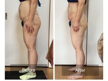 リノリー(rinory)/脂肪冷却×パワーレメディ