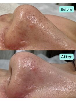 マーレ(MARE)/毛穴ケア特化コース