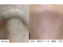 アレイズ(ARAYS)/症例(脱毛)