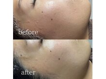 赤み・乾燥　改善