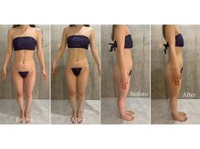 ブランカ(BLANCA)/インディバ/ウエスト腰回り/痩身