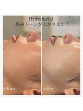 ハーシークレット(Her secret)/ハイドラ毛穴洗浄